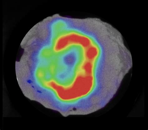 Imaging Case 8: Pancreatic adenocarcinoma - International – English