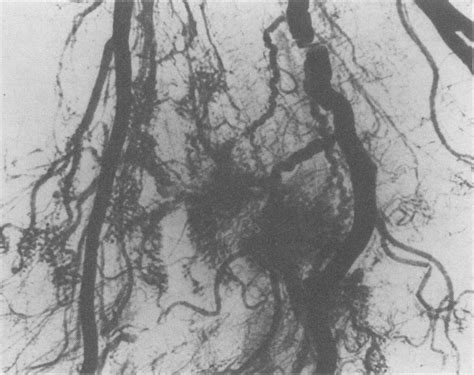 Microradiograph of an area of angiodysplasia. The cluster of abnormal ...