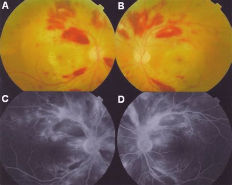 Fundus color photographs showing cotton-wool spots, exudates, multiple ...