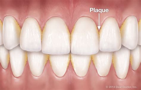 How Much Is Plaque Removal at Marvin Macias blog