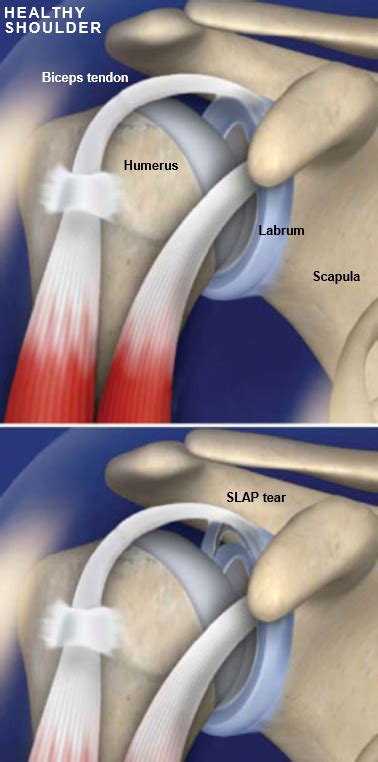 SLAP Tear | Central Coast Orthopedic Medical Group