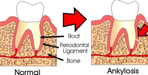 What are Ankylosed Teeth? | Ask an Orthodontist.com