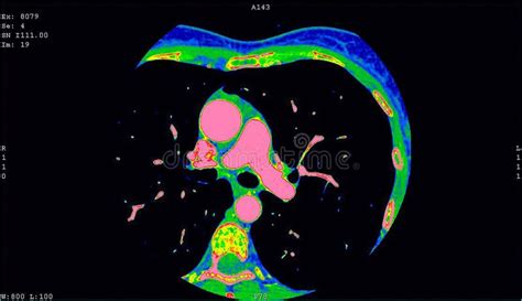 Computerized Tomography CT Coronary Angiogram. Axial Contrast of the ...