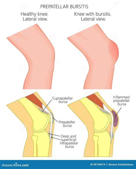 Knee Bursitis_Prepatellar Bursitis Stock Vector - Illustration of ...