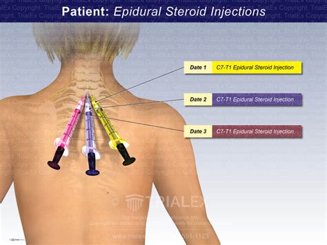 Epidural Steroid Injections - TrialExhibits Inc.