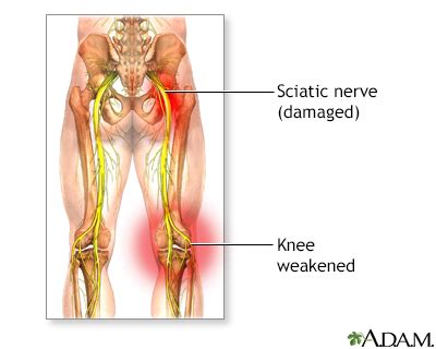 Sciatica Symptoms, Doctors, Treatments, Advances & More | MediFind