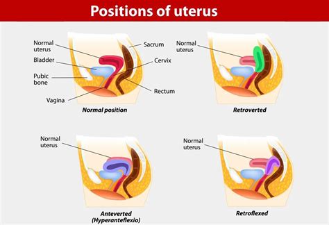 Anteverted Uterus: Causes, Symptoms, Diagnosis & Treatment