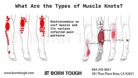 Calf Muscle Knots - All You Need to Know About These Painful Lumps ...