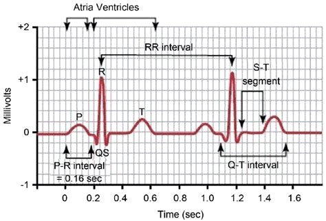 Normal electrocardiogram tracing: Waves, intervals and segments ...