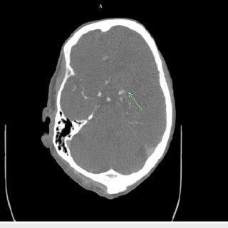 CT angiogram of the head with contrast The arrow indicates proximal ...