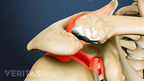 What is Acromioclavicular Arthritis (AC Joint Arthritis)? | Arthritis ...