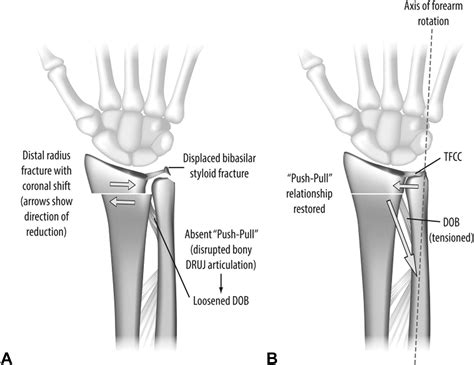 Distal Radius Fracture Anatomy | Images and Photos finder