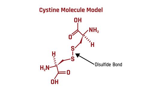 Cystine Kidney Stones- The Nastiest of All | Stone Relief