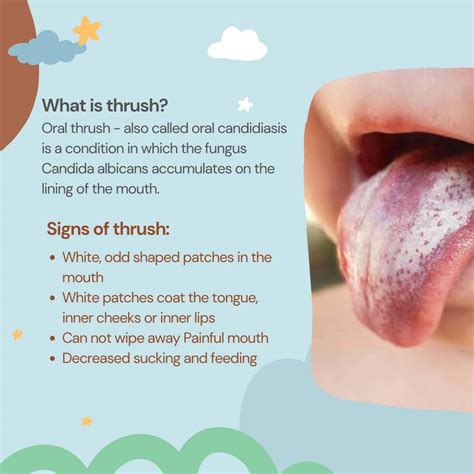 Normal Tongue Vs Thrush