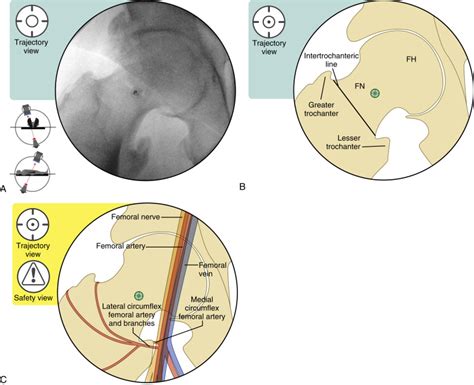 Intraarticular Hip Injection—Anterior Approach: Fluoroscopic Guidance ...