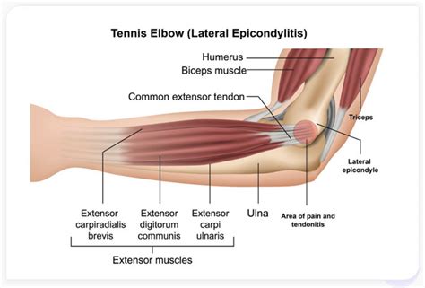 Tennis Elbow - Regenerative Medicine Treatment | StemX Clinic