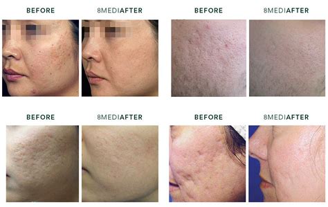 Acne Scar Removal Treatment - Safe and effective Acne Scar Treatment