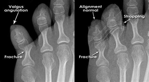 Introduction to Trauma X-ray - Fracture treatment