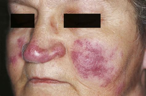 Lupus pernio causes, symptoms, diagnosis, treatment & prognosis