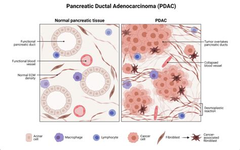 | Histology of pancreatic ductal adenocarcinoma. Created with ...