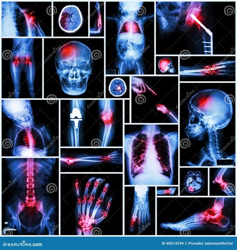 Collection Of X-ray Multiple Part Of Human,Orthopedic Operation And Multiple Disease (Shoulder ...