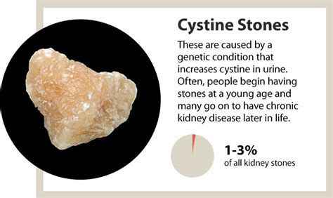 Kidney stones - a marker of overall kidney health - News | UAB