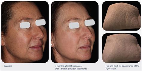 Fractionated laser for fine lines & wrinkles – QSD