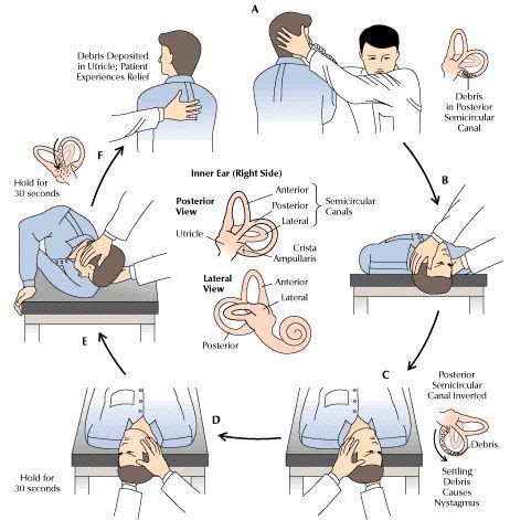 inner ear crystals Epley maneuver | Positional Vertigo: Get Medical ...