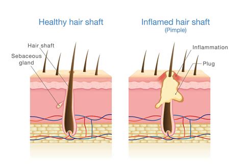 Inflamed Hair Follicles - Head / Scalp Folliculitis Treatment ...