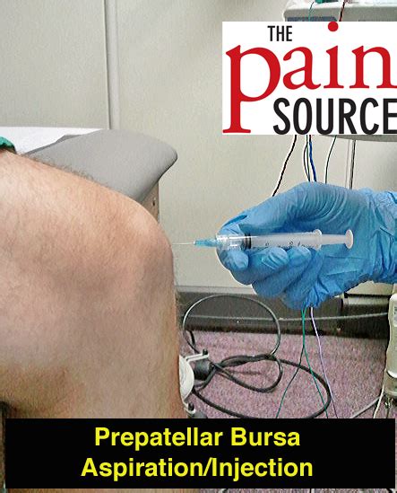 Knee Bursitis Prepatellar Bursitis Everything You Need To Know Dr ...