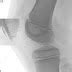 Patellar Sleeve Avulsion Fracture-Plain Film - Sumer's Radiology Blog