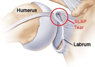 SLAP Tear: Causes, Symptoms & Treatment of Shoulder Labrum Tear