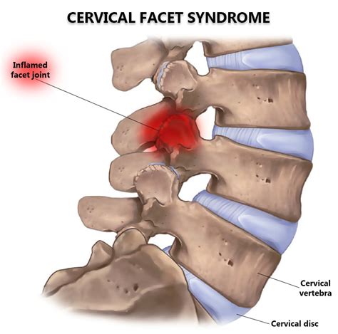 Cervical Facet Syndrome NJ & NYC | Cervical Osteoarthritis Treatment in ...