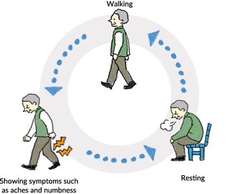 About lumbar spinal canal stenosis | Otsuka Pharmaceutical Co., Ltd.