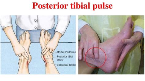 [Download 43+] 36+ Posterior Tibial Pulse Vs Dorsalis Pedis Gif jpg