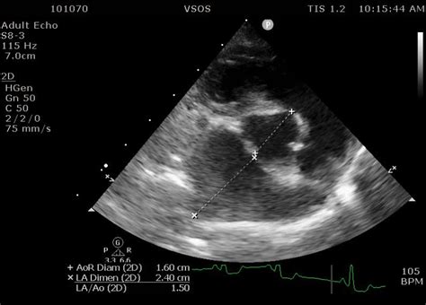 Myxomatous Mitral Valve Degeneration (MMVD) - My Vet Animal Hospital