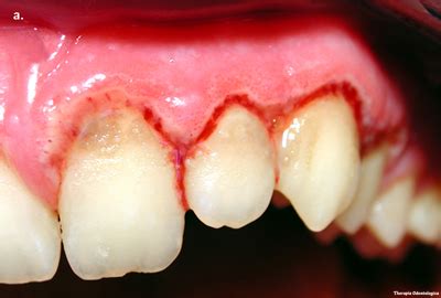 Necrotizing Ulcerative Gingivitis Before And After