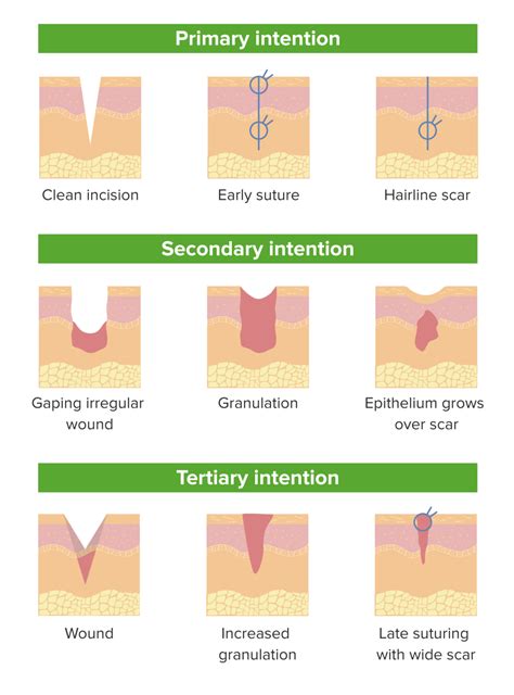 Wound Healing | Concise Medical Knowledge