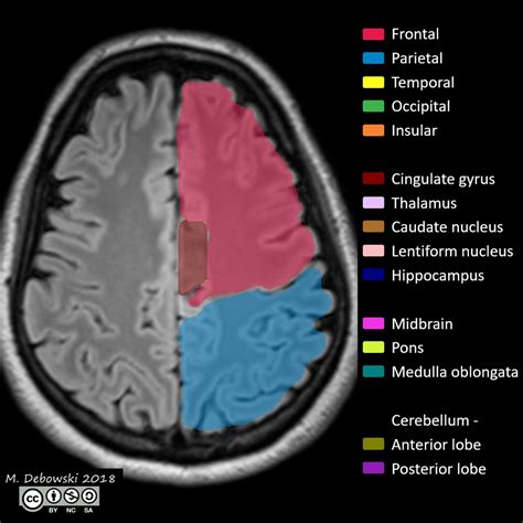 Brain lobes - annotated MRI (Radiopaedia 61691-69700 Axial) - NC Commons