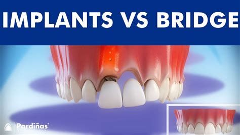 Dental Implants VS Tooth bridge - Comparison © - Dental Clinic