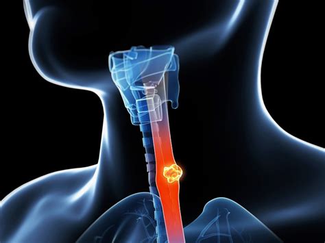 Esophagus Cancer Radiology