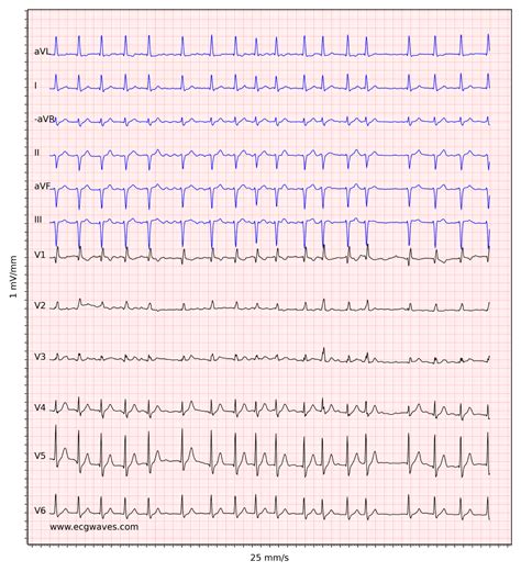 Atrial fibrillation: ECG, classification, causes, risk factors ...