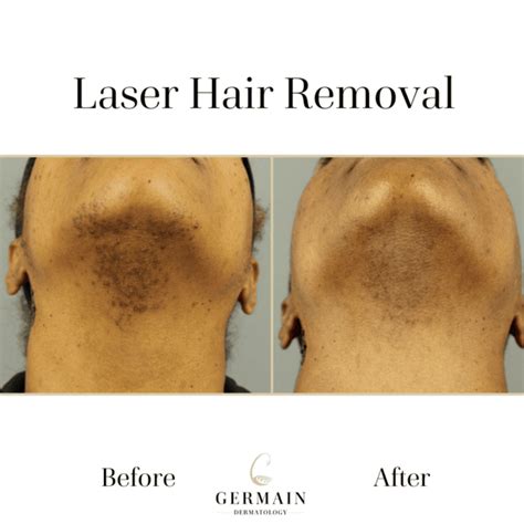 Laser Hair Removal Before & After | Mt Pleasant, Summerville