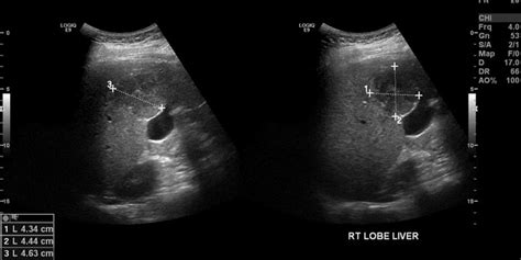 Hepatic Hemangioma Ultrasound