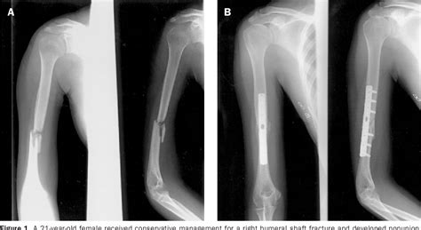 Figure 1 from Treatment of Nonunion of Humeral Shaft Fracture with ...