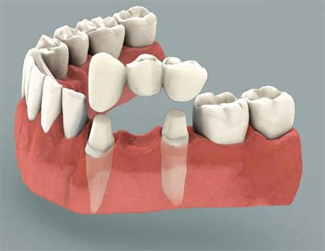 Dental Bridge - Procedure, Dental Bridge Vs Dental Implant