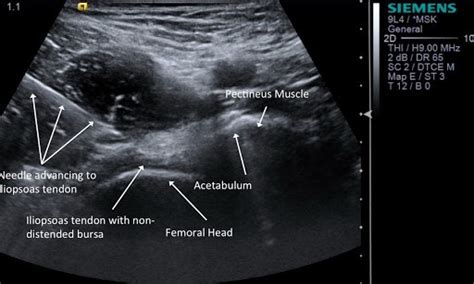 Iliopsoas Bursa Injection Ultrasound | Hot Sex Picture