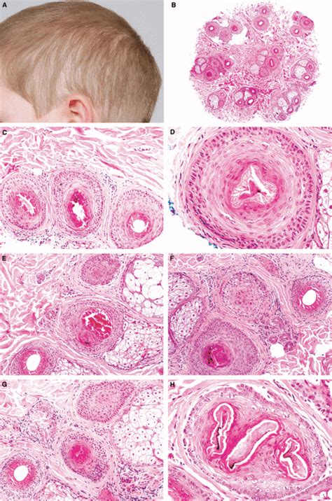 Scarring Alopecia Histology