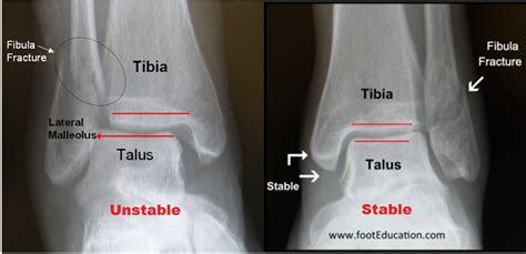 Weber B ankle fracture