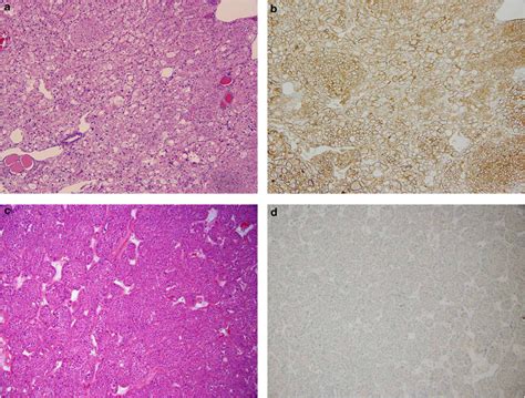 Chromophobe RCC (H& × 100). (b) FXYD2 immunostain of chromophobe RCC ...